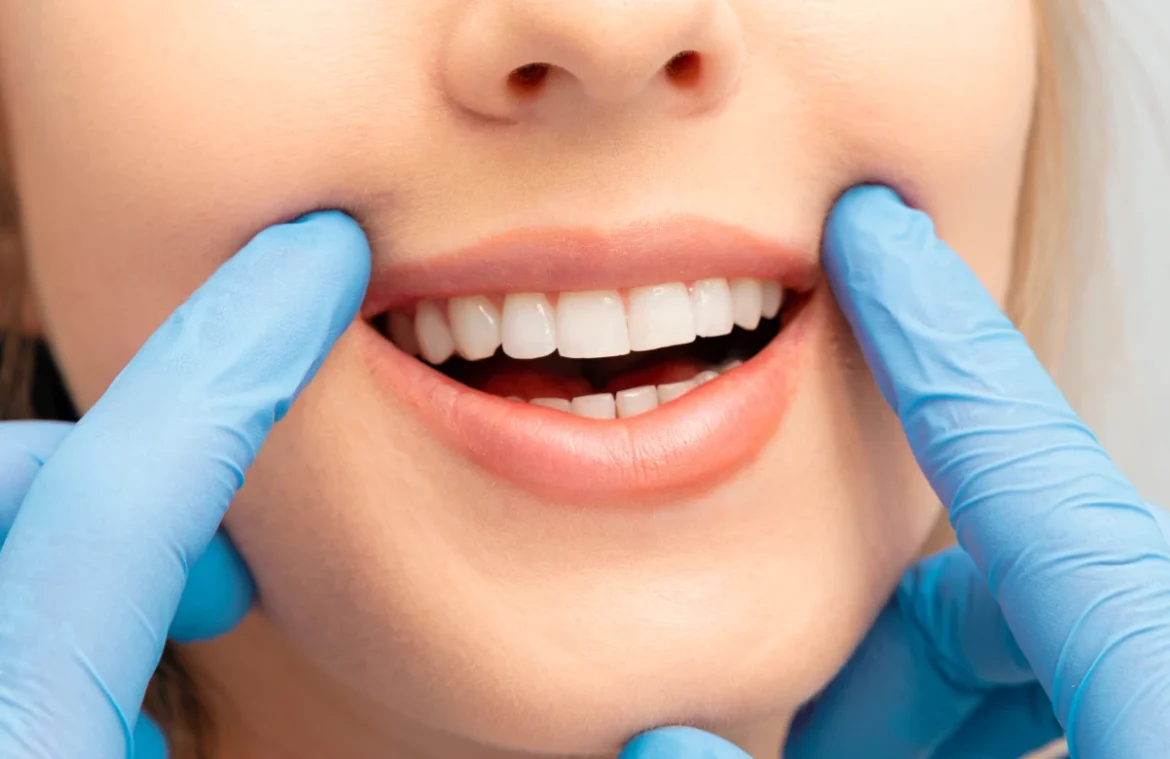 Teeth-Whitening-kamloops