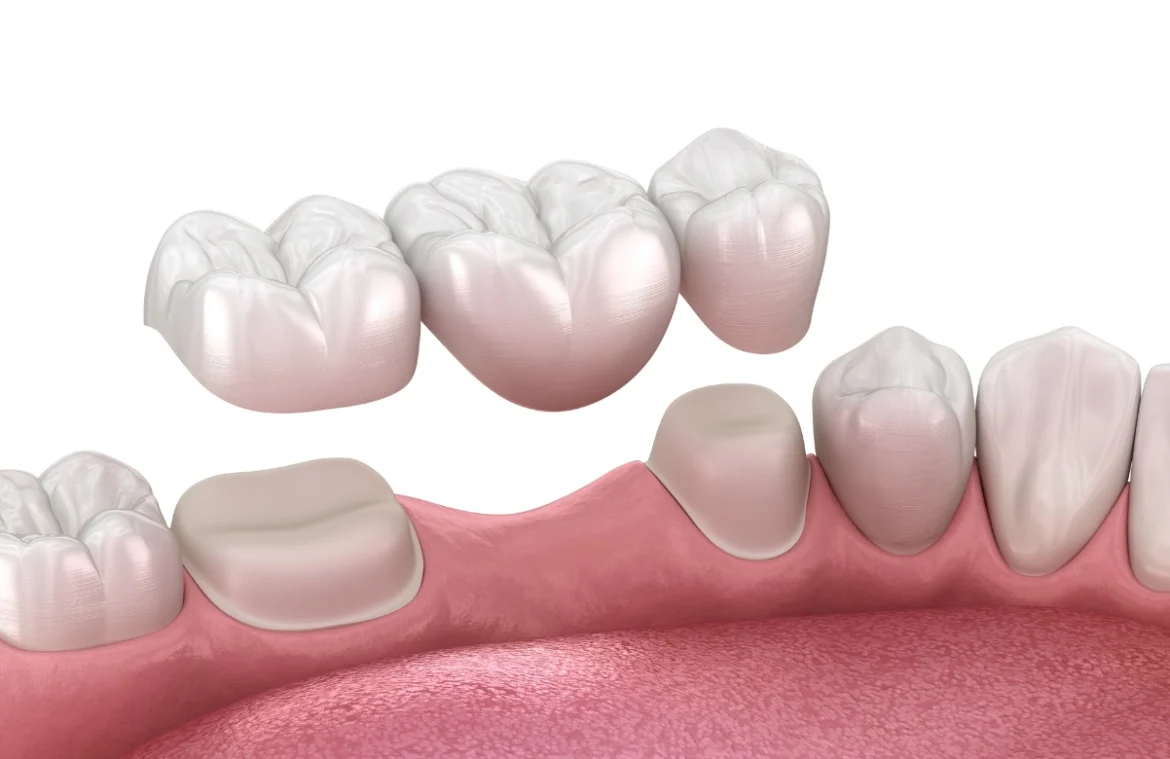 dental-bridges-kamloops