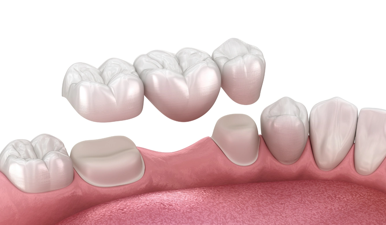 Dental Bridges Kamloops