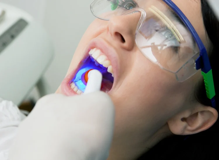 Dental-Fillings