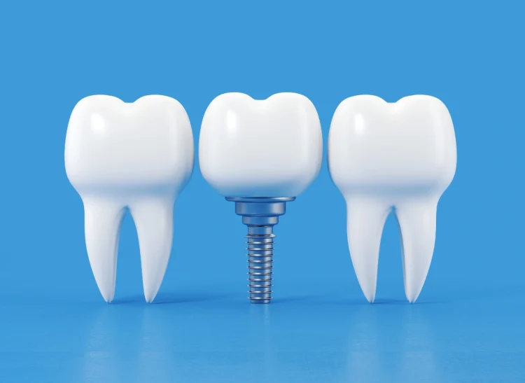 Dental-Implants-near-me