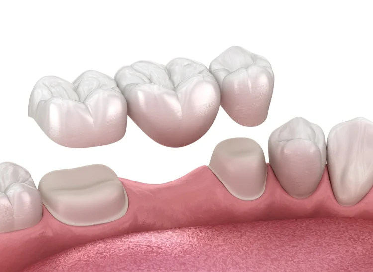dental-bridges-kamloops